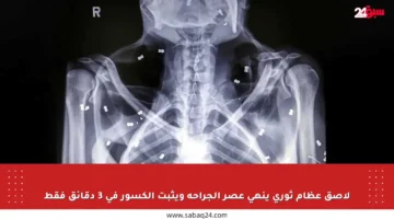 لاصق عظام ثوري ينهي عصر الجراحة ويثبت الكسور في 3 دقائق فقط